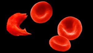 sickle-cell-anemia