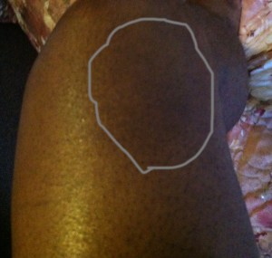 My second-degree leg burn, 40 years later - darker area circled is faded mark that was once on the right side of my right calf, August 5, 2014. (Donald Earl Collins).